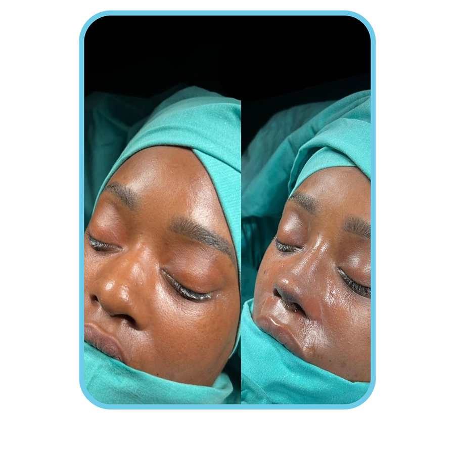 Medical Planet Ethnic Rhinoplasty