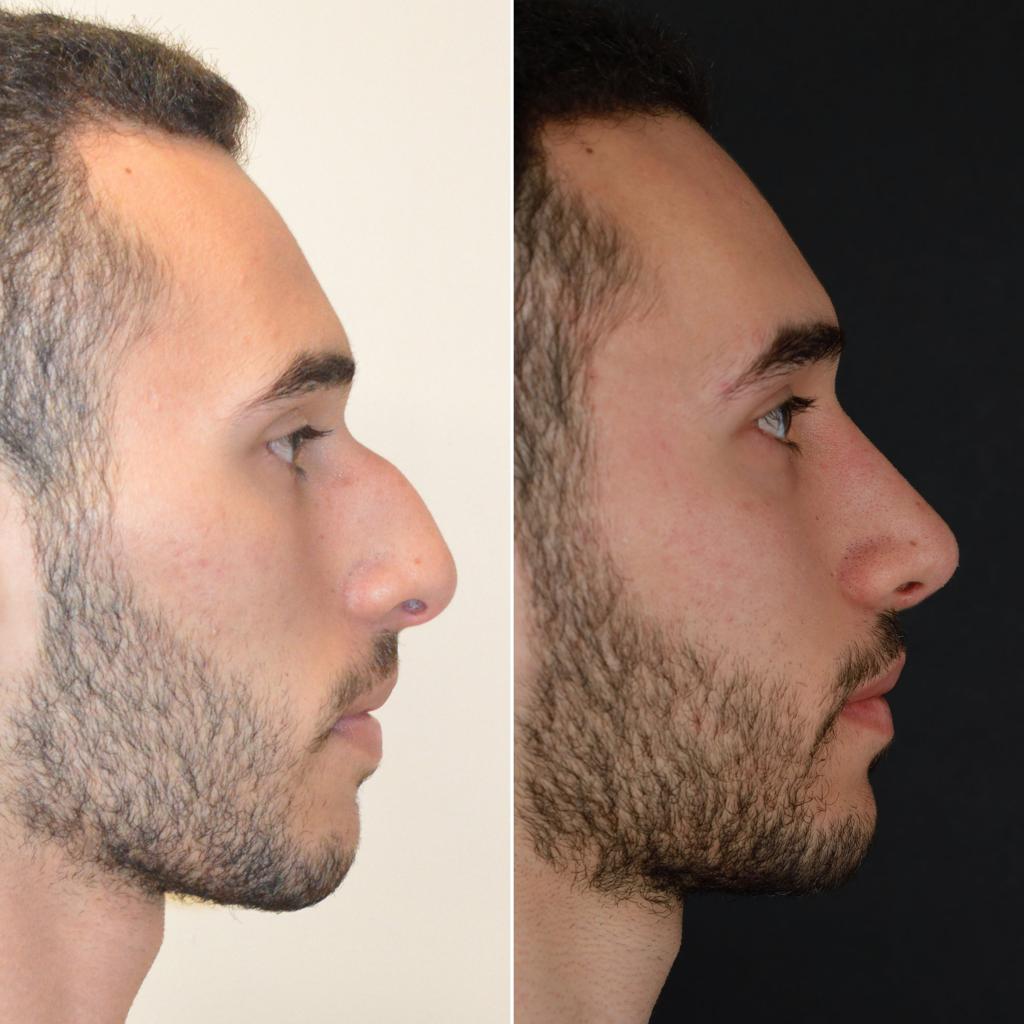 تجميل الأنف للرجال في تركيا