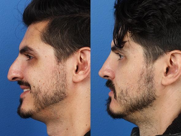 تجميل الأنف للرجال في تركيا